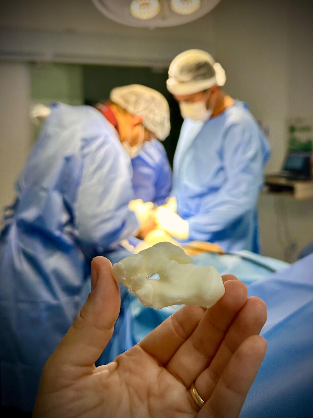 Modelo ósseo impresso em 3D, segurado no centro cirúrgico durante o procedimento